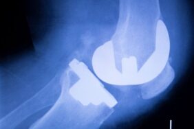 diz kıkırdak ameliyatı (1)