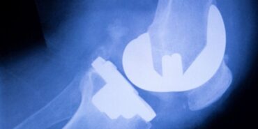 diz kıkırdak ameliyatı (1)