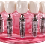 implant tedavisi (1)