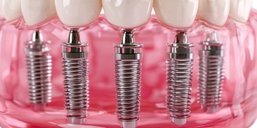 implant tedavisi (1)